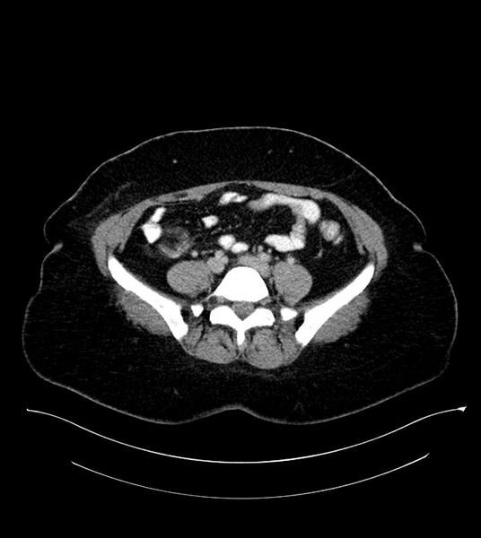 File:Anterior abdominal wall CSF pseudocyst (CSFoma) (Radiopaedia 79453-92571 A 63).jpg