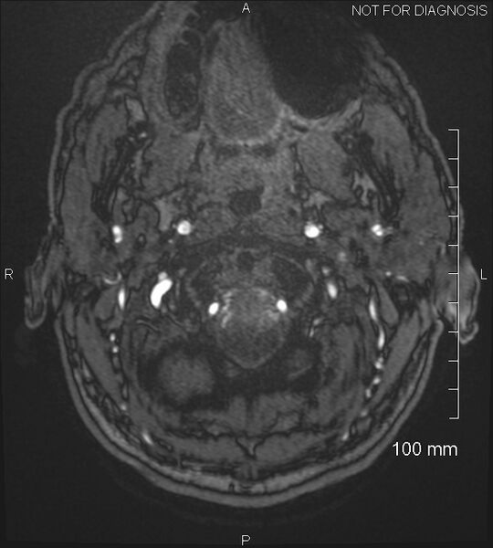 File:Anterior cerebral artery aneurysm (Radiopaedia 80683-94127 Axial MRA 1).jpg