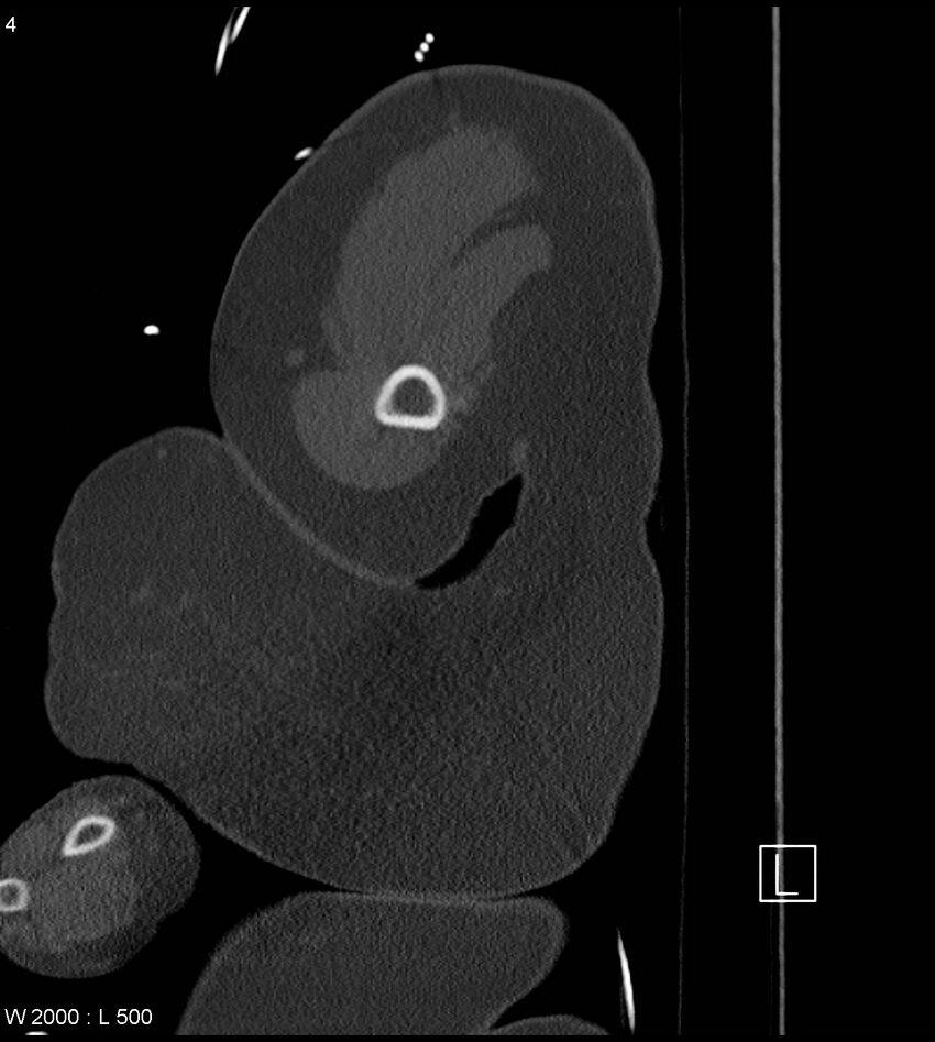 Anterior shoulder dislocation (CT) (Radiopaedia 59032-66309 Sagittal bone window 2).jpg