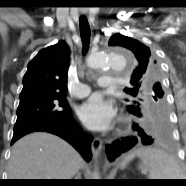 File:Aortic arch false aneurysm (Radiopaedia 14667-14588 B 7).jpg