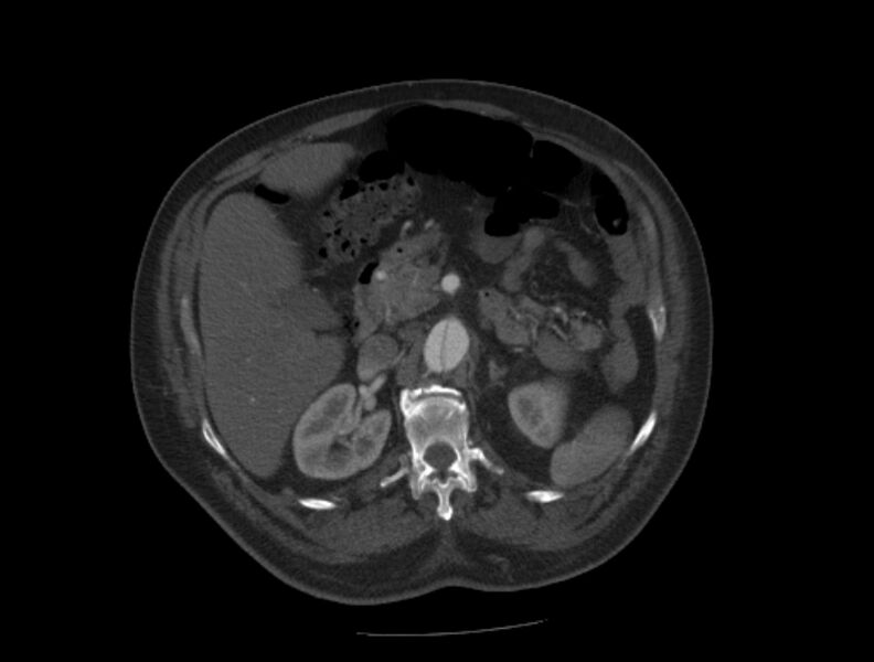 File:Aortic dissection (Radiopaedia 28802-29105 A 51).jpg