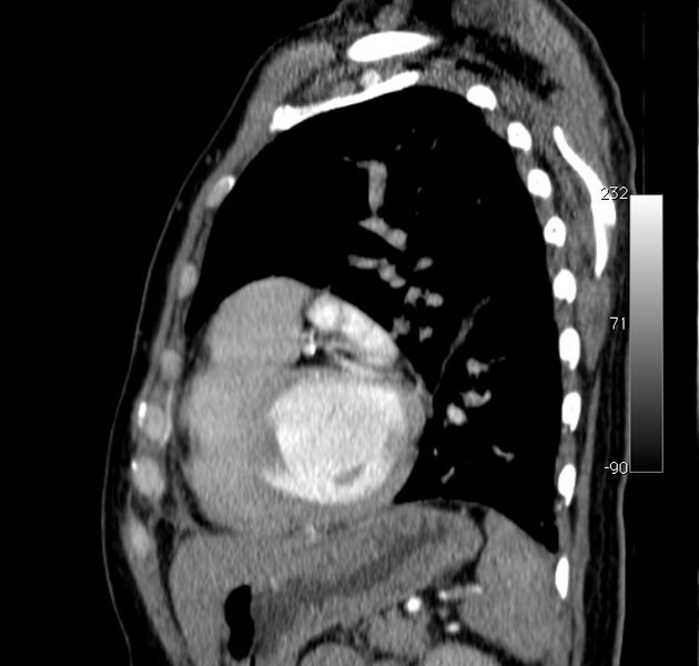 File:Aortic dissection - Stanford type A (Radiopaedia 29247-29659 C 12).jpg