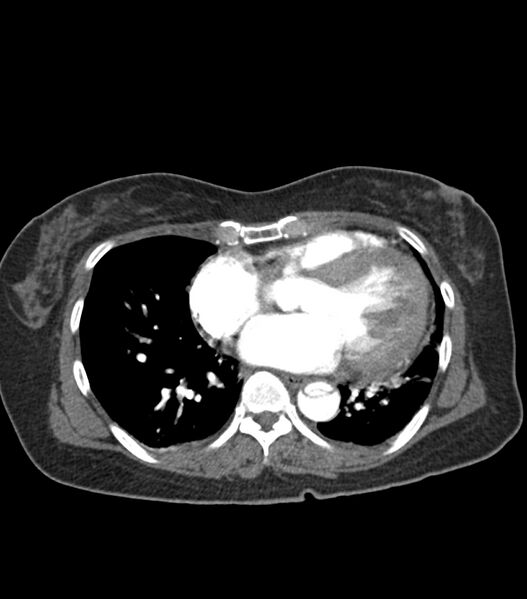 File:Aortic dissection with renal ischemia (Radiopaedia 76573-88338 A 45).jpg