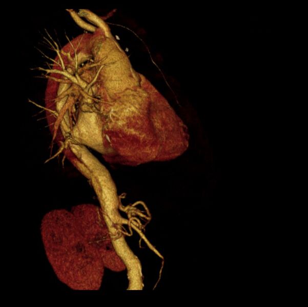 File:Aortic dissection with rupture into pericardium (Radiopaedia 12384-12647 D 9).jpg