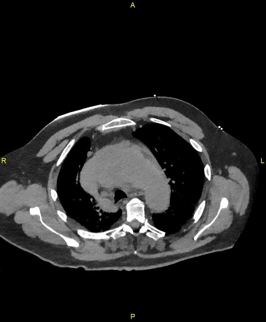 Aortic rupture (Radiopaedia 88822-105594 Axial non-contrast 59).jpg
