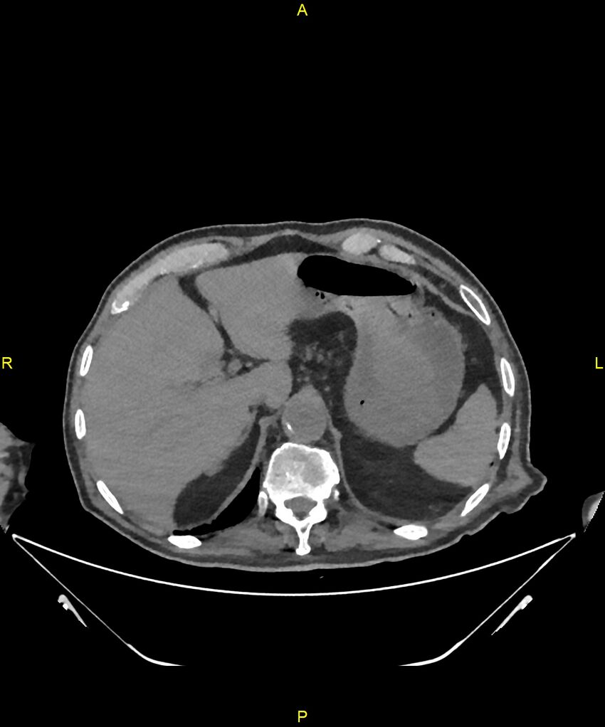 Aortoenteric fistula (Radiopaedia 84308-99603 Axial non-contrast 60).jpg
