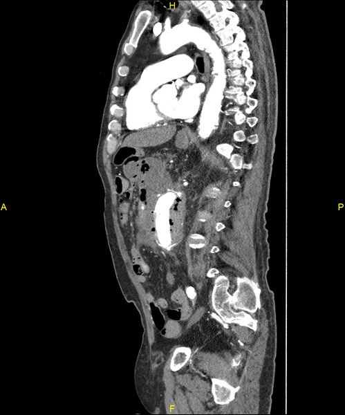 File:Aortoenteric fistula (Radiopaedia 84308-99603 C 204).jpg