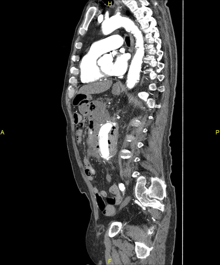 Aortoenteric fistula (Radiopaedia 84308-99603 C 204).jpg