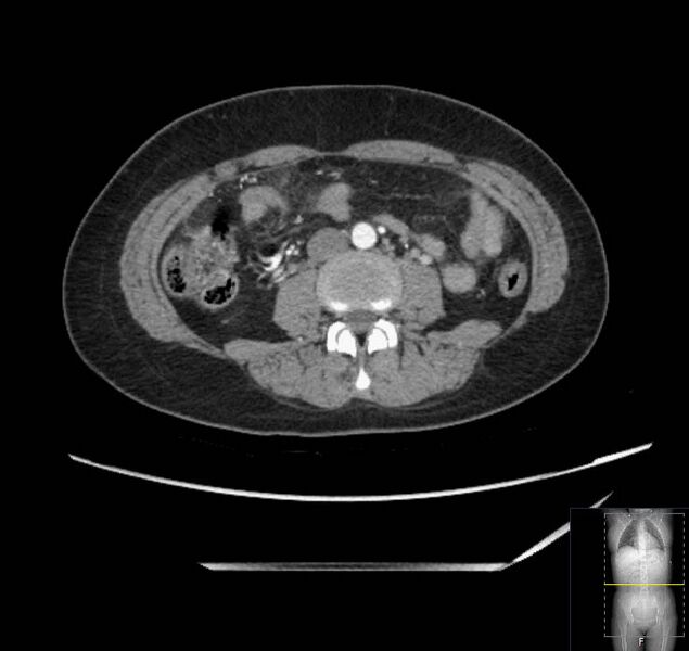 File:Appendicitis (CT angiogram) (Radiopaedia 154713-127660 Axial 69).jpg