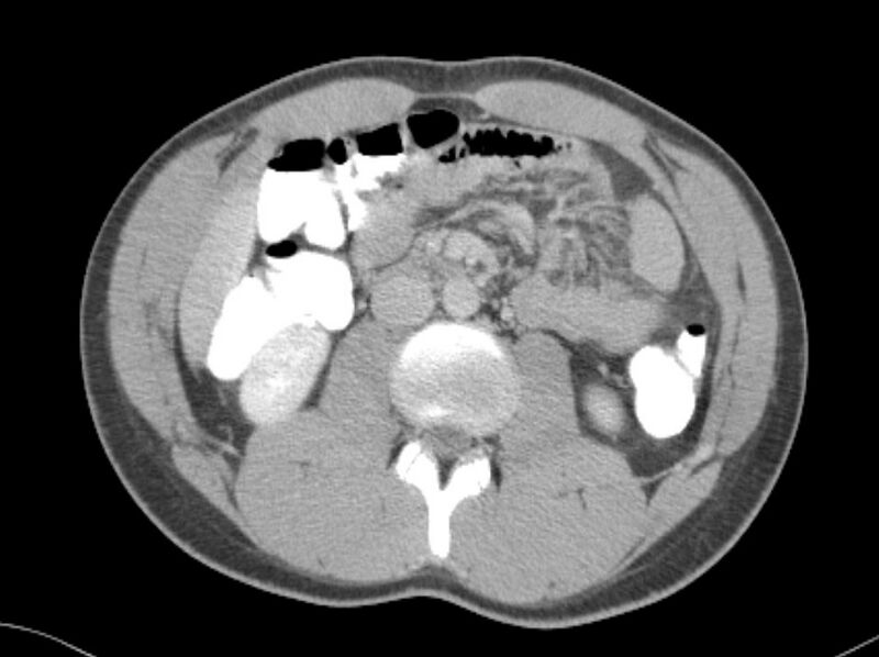 File:Appendicitis and incidental foregut duplication cyst (Radiopaedia 52962-58916 A 28).jpg