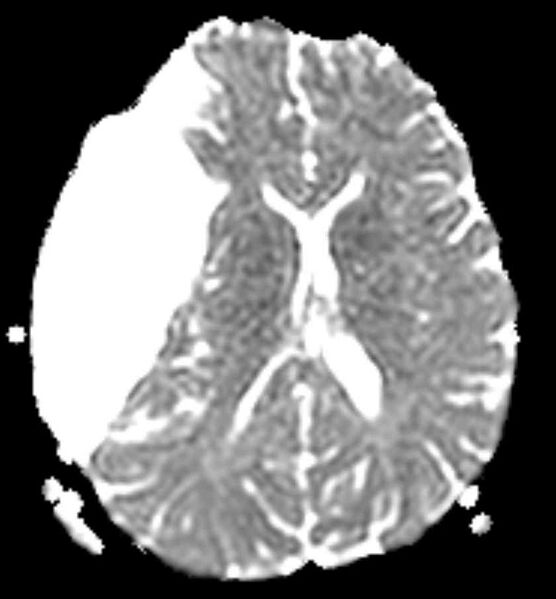 File:Arachnoid cyst- extremely large (Radiopaedia 68741-78451 Axial ADC 15).jpg