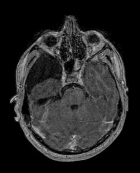 File:Arachnoid cyst- extremely large (Radiopaedia 68741-78451 Axial T1 C+ 26).jpg
