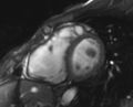 Arrhythmogenic right ventricular cardiomyopathy (Radiopaedia 69564-79464 short axis cine 150).jpg