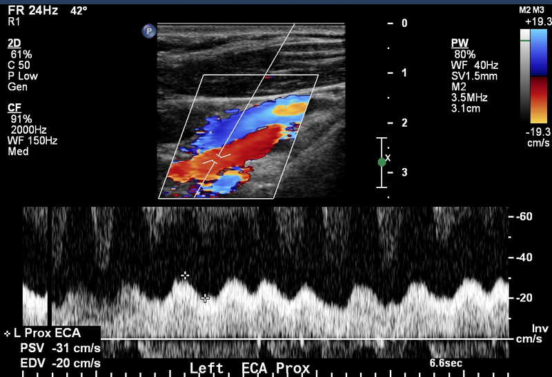 File:Arterial Doppler in left ventricular assist device patients (Radiopaedia 18113-17895 C 1).png