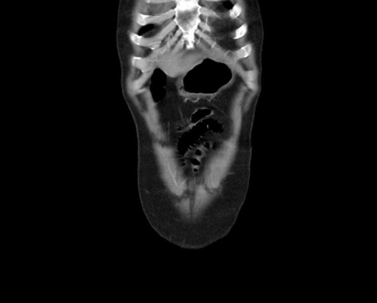 File:Arterial occlusive mesenteric ischemia (Radiopaedia 84641-100060 B 4).jpg