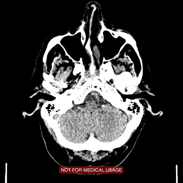 File:Artery of Percheron infarction (Radiopaedia 28679-28967 Axial non-contrast 21).jpg