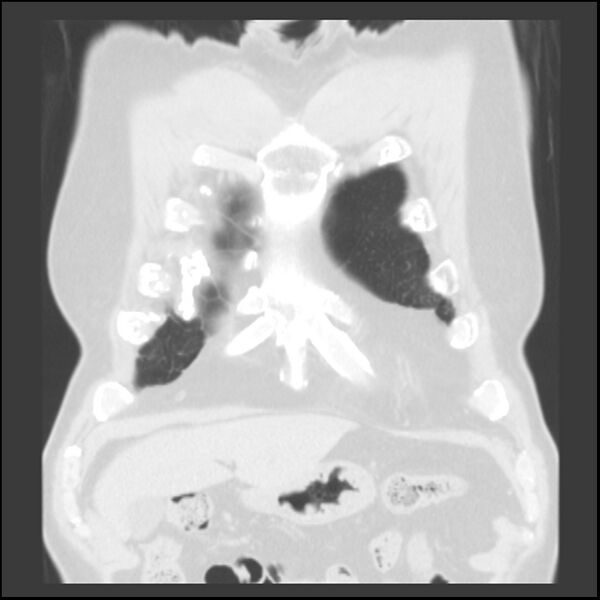 File:Asbestos-related pleural plaques (Radiopaedia 39069-41255 Coronal lung window 77).jpg