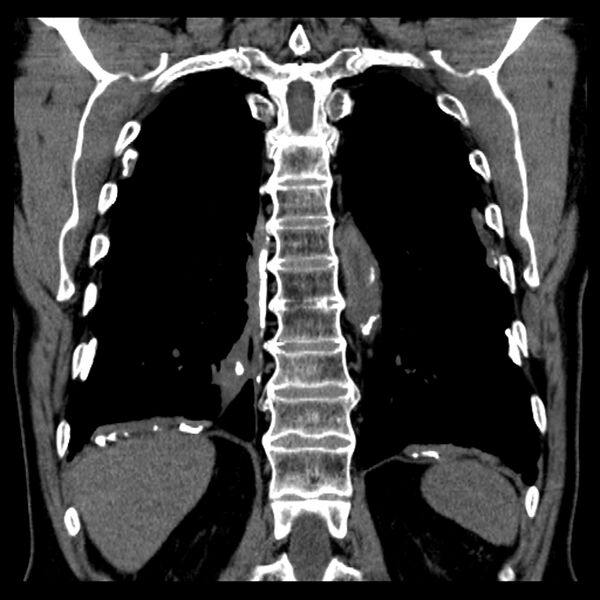 File:Asbestos-related pleural plaques (Radiopaedia 39069-41255 Coronal non-contrast 20).jpg
