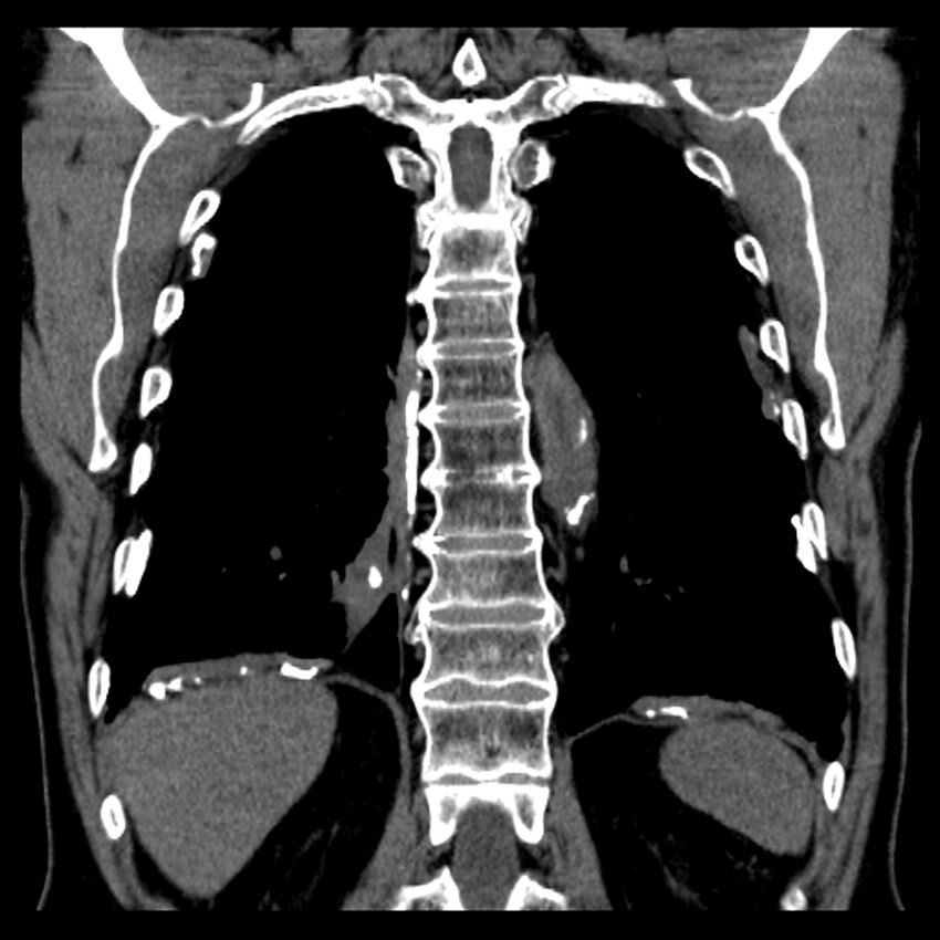 Asbestos-related pleural plaques (Radiopaedia 39069-41255 Coronal non-contrast 20).jpg