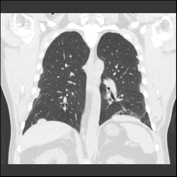 File:Asbestosis (Radiopaedia 45002-48961 Coronal lung window 2).jpg