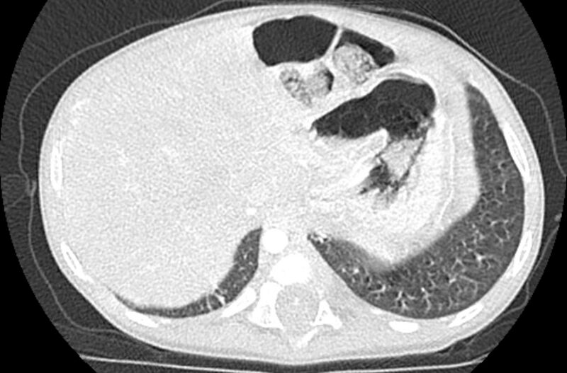 File:Asplenia syndrome (Radiopaedia 73083-83792 Axial lung window 69).jpg