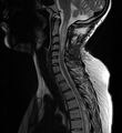 Astrocytoma - spinal cord (Radiopaedia 69769-79758 Sagittal T2 6).jpg