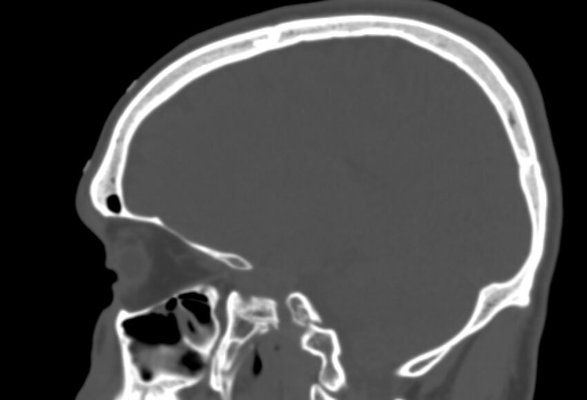 Asymptomatic occipital spur (Radiopaedia 87753-104201 Sagittal bone window 190).jpg
