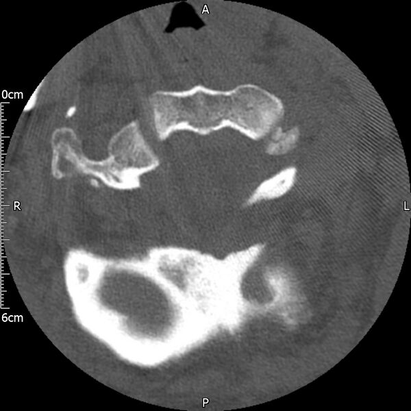 File:Atlas fracture with Currarino type A congenital defect (Radiopaedia 71747-82144 Axial bone window 43).jpg