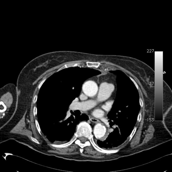 File:Atypical dissection of the thoracic aorta (Radiopaedia 10975-11393 A 36).jpg