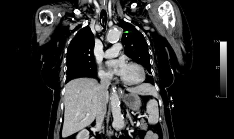 File:Atypical dissection of the thoracic aorta (Radiopaedia 10975-78320 B 15).jpg
