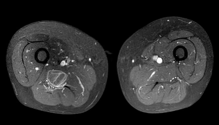 Atypical lipomatous tumor - thigh (Radiopaedia 68975-78734 Axial T1 C+ fat sat 50).jpg