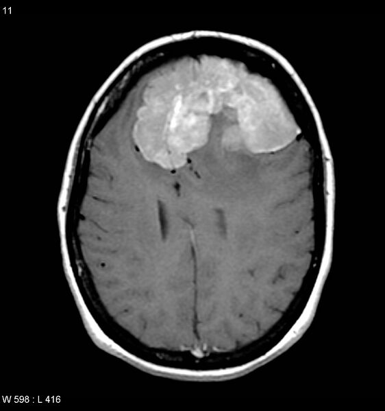File:Atypical meningioma (WHO grade II) (Radiopaedia 7762-8586 D 7).jpg