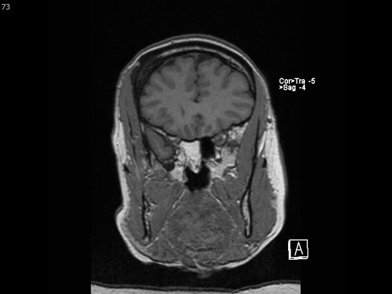 File:Atypical meningioma - intraosseous (Radiopaedia 64915-74572 Coronal T1 73).jpg
