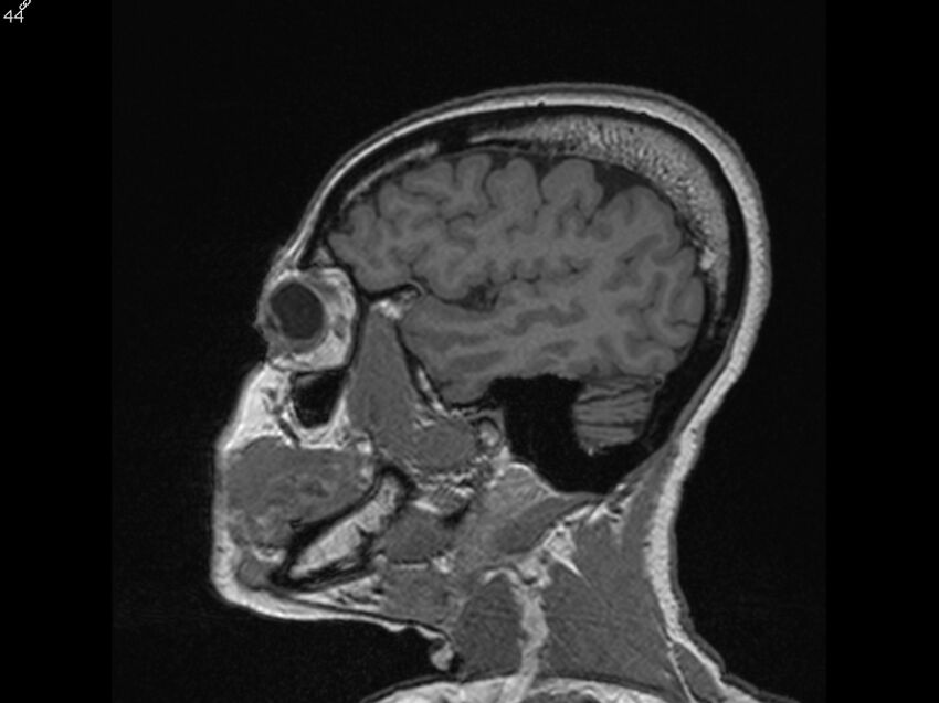 Atypical meningioma - intraosseous (Radiopaedia 64915-74572 Sagittal T1 44).jpg