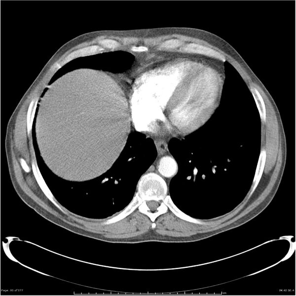 File:Atypical pneumonia - Q fever (Radiopaedia 21993-21989 C+ arterial phase 37).jpg