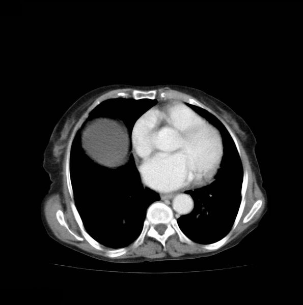 File:Autosomal dominant polycystic kidney disease (Radiopaedia 16777-16490 A 3).jpg