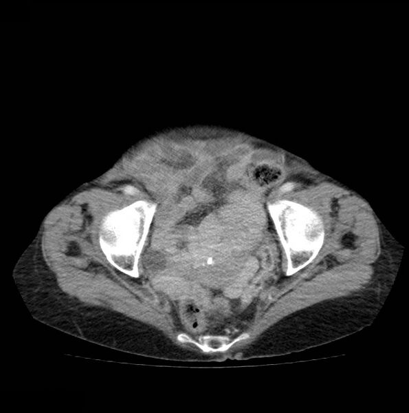 File:Autosomal dominant polycystic kidney disease (Radiopaedia 16777-16490 A 51).jpg