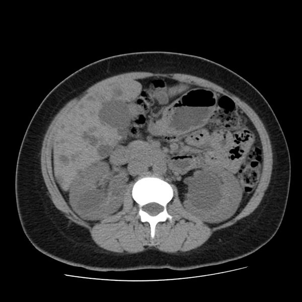 File:Autosomal dominant polycystic kidney disease (Radiopaedia 23061-23093 Axial non-contrast 27).jpg