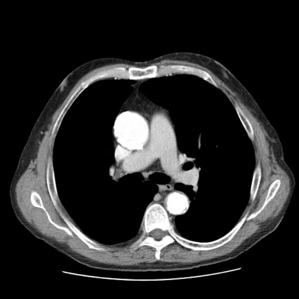 File:Autosomal dominant polycystic kidney disease (Radiopaedia 27851-28094 B 26).jpg
