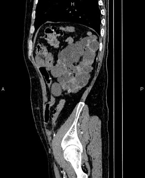 File:Autosomal dominant polycystic kidney disease (Radiopaedia 87830-104287 C 75).jpg