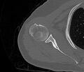 Avulsion fracture - greater tuberosity of humerus (Radiopaedia 71216-81514 Axial bone window 37).jpg