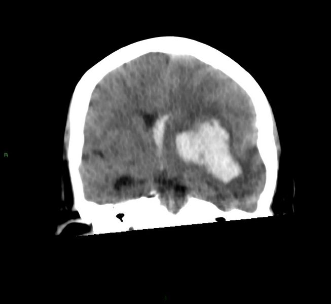 File:Basal ganglia hemorrhage (Radiopaedia 58759-65981 Coronal non-contrast 41).jpg
