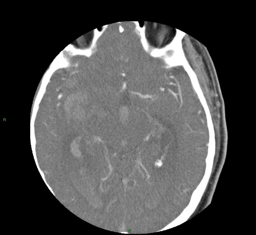 Basal ganglia hemorrhage (Radiopaedia 58763-65985 D 84).jpg