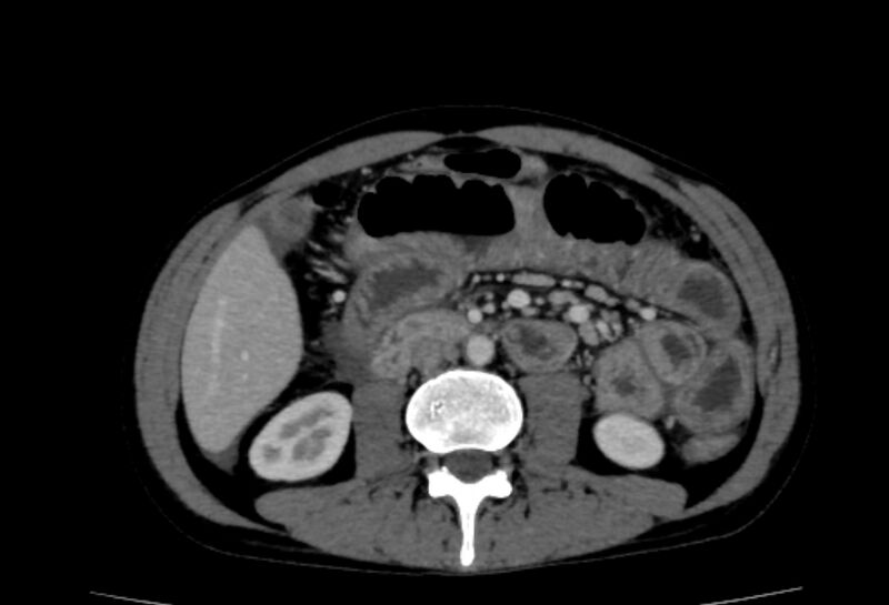 File:Behçet's disease- abdominal vasculitis (Radiopaedia 55955-62570 A 39).jpg