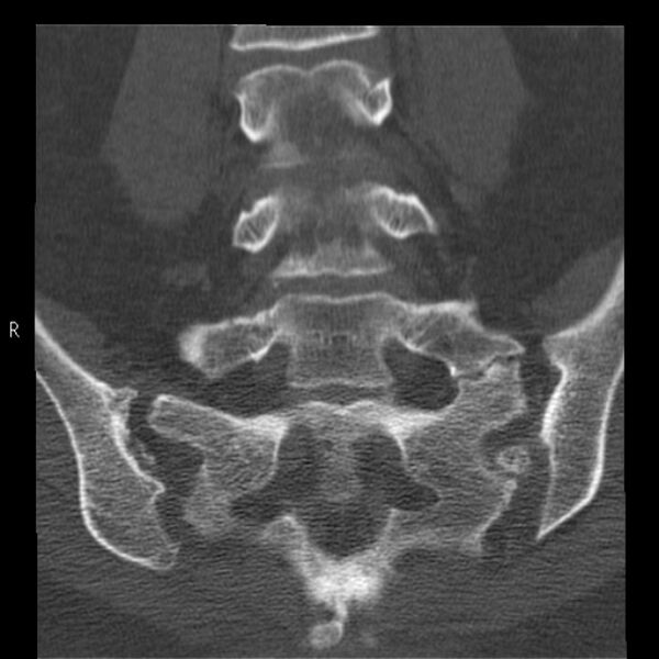 File:Bertolotti syndrome (Radiopaedia 24864-25128 Coronal bone window 28).jpg