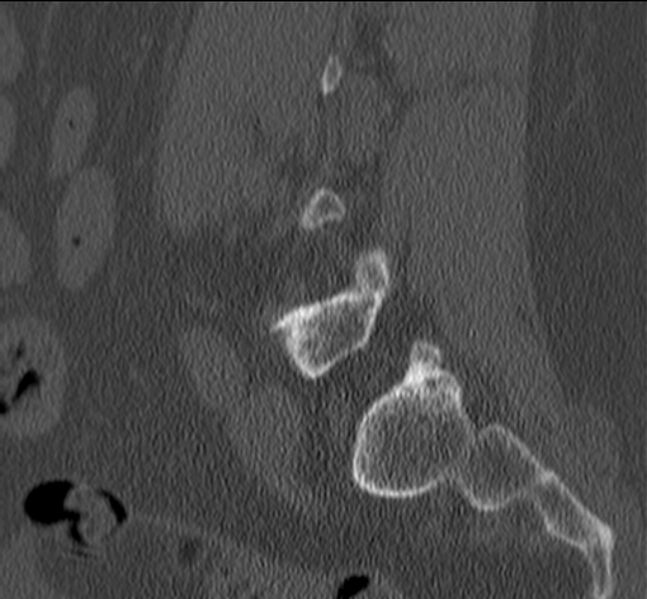 File:Bertolotti syndrome (Radiopaedia 24864-25128 Sagittal bone window 41).jpg
