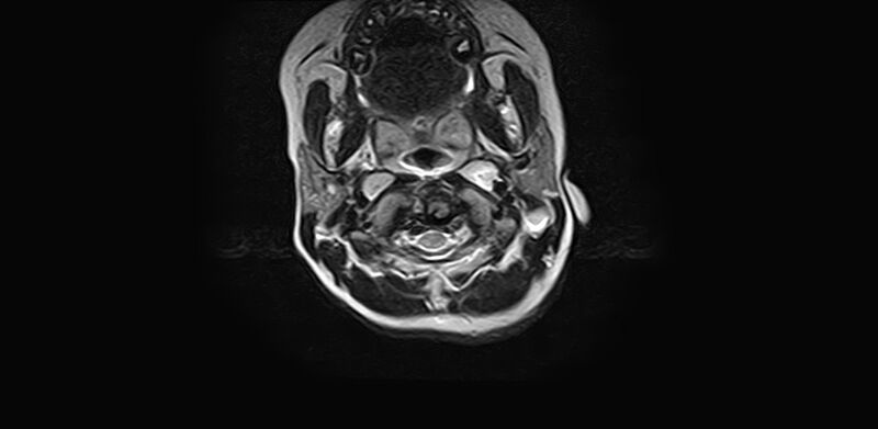 File:Bilateral Sprengel deformity with Klippel-Feil syndrome (Radiopaedia 66395-75650 Axial T2 6).jpg