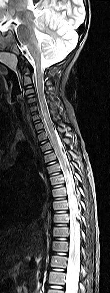 File:Bilateral Sprengel deformity with Klippel-Feil syndrome (Radiopaedia 66395-75650 Sagittal STIR 6).jpg