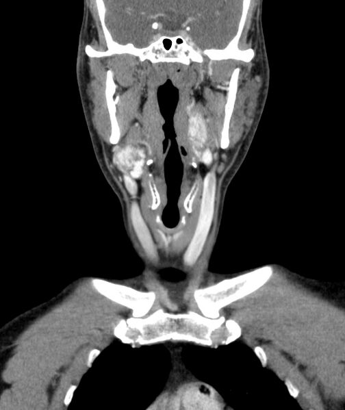 File:Bilateral carotid body tumors (Radiopaedia 52899-58827 B 5).jpg