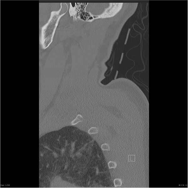 File:Bilateral cervical ribs (Radiopaedia 25868-26017 Sagittal bone window 1).jpg